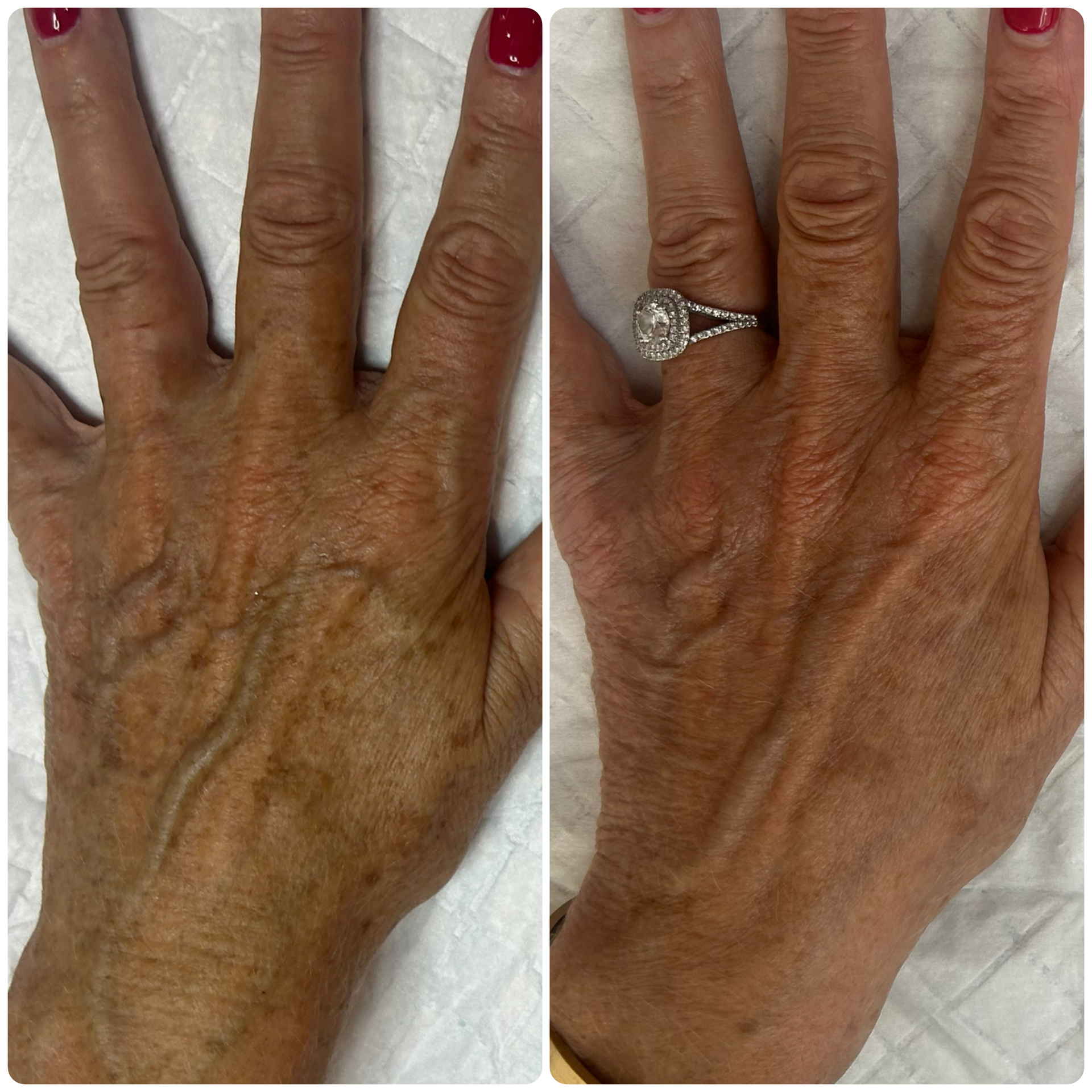 Lumecca IPL targets Age Spots