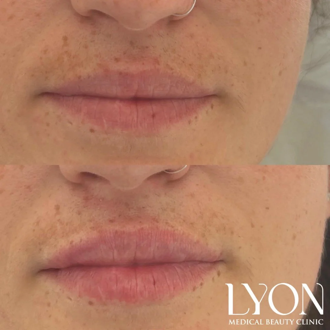 Copy of Before - 7.png