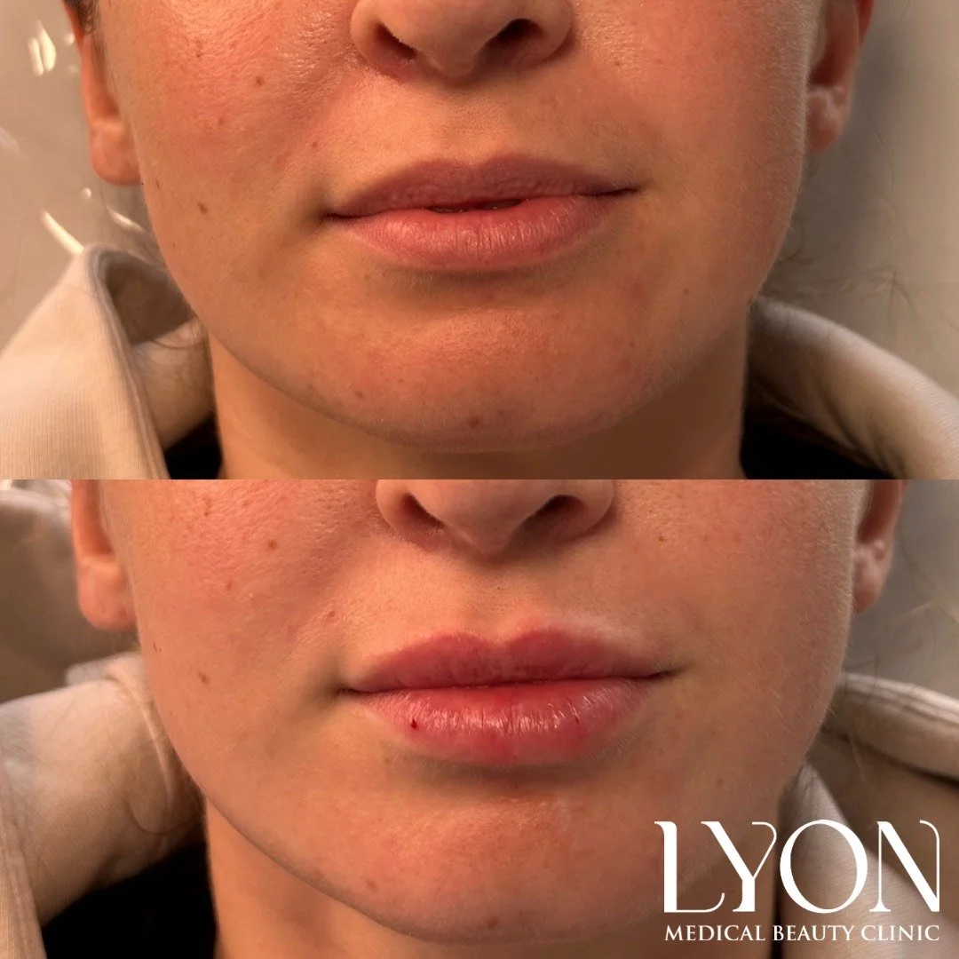 Copy of Before - 33.png