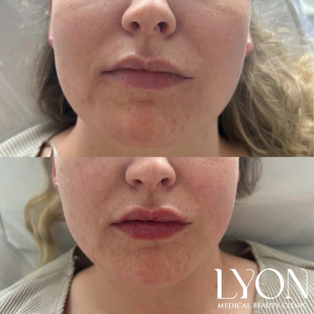 Copy of Before - 36.png