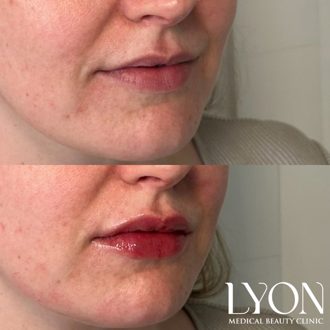 Copy of Before - 37.png