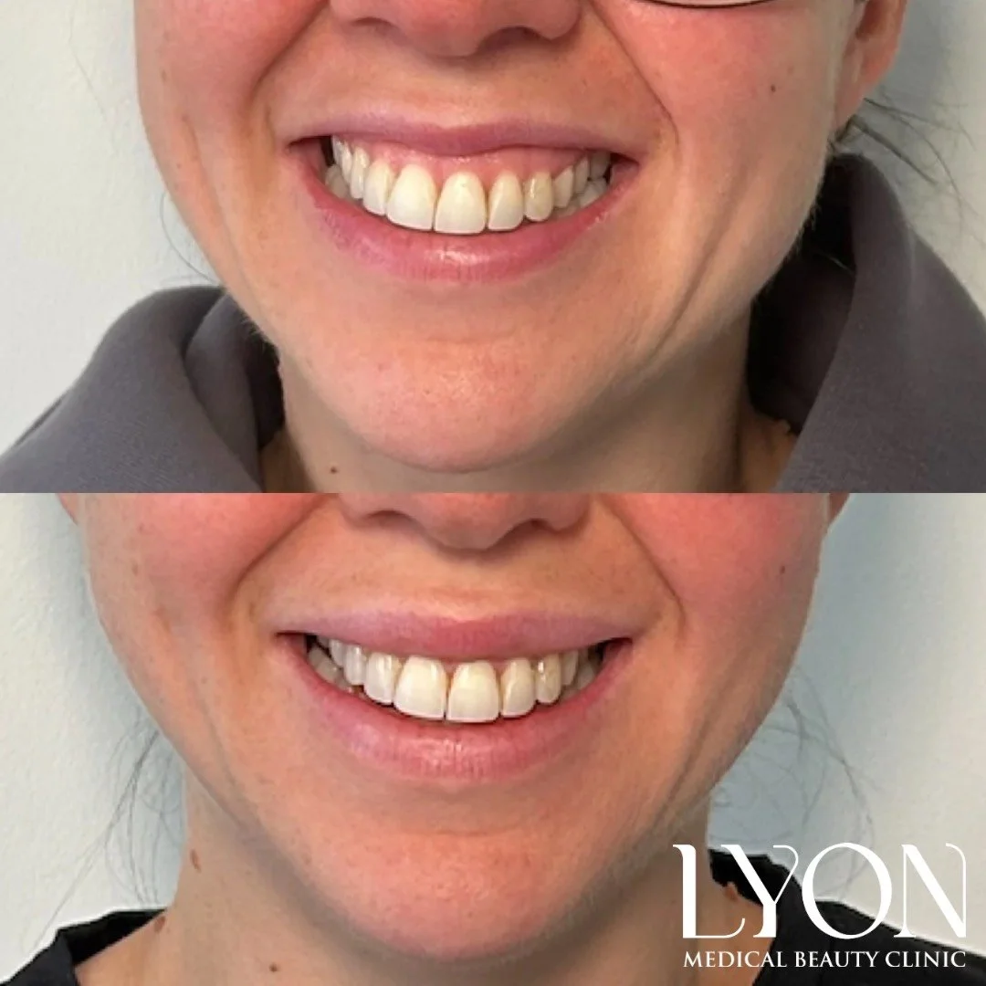 Copy of Before - 35.png