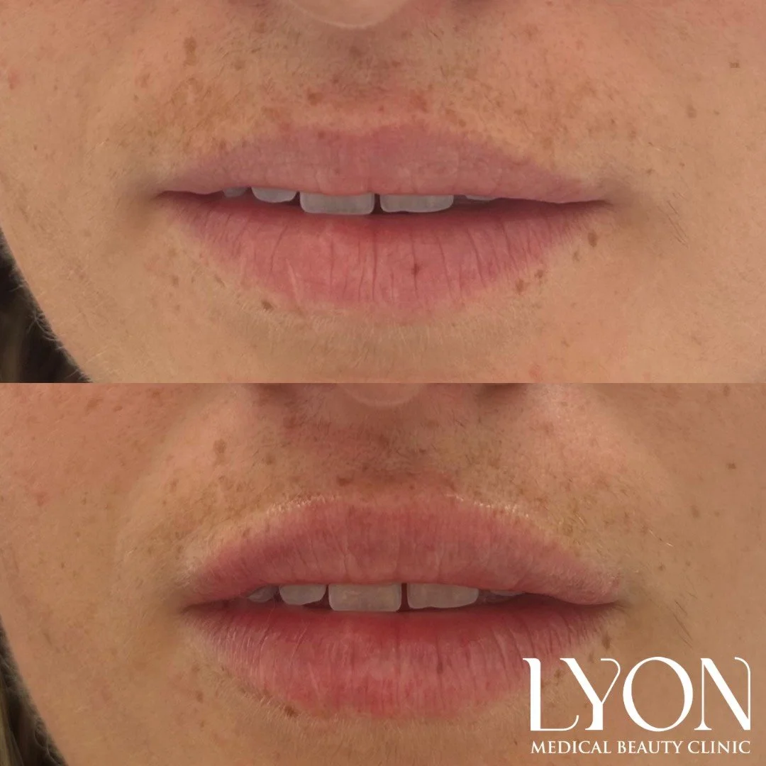 Copy of Before - 9.png