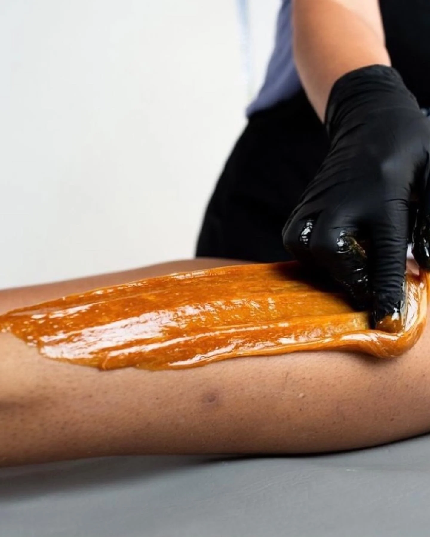 Person receiving a caramel waxing treatment on their arm, wearing a black glove, in a clinical setting.