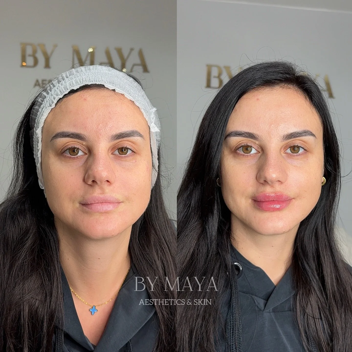 A little boost to the natural lip shape for a soft, plumper look. Keeping it subtle 
________________________

#lipaugmentationlondon #flatlipsuk &lrm;#شفاه #l&egrave;vres #lipfillersbattersea  #lippen #labiosperfeitos #嘴唇 #губы