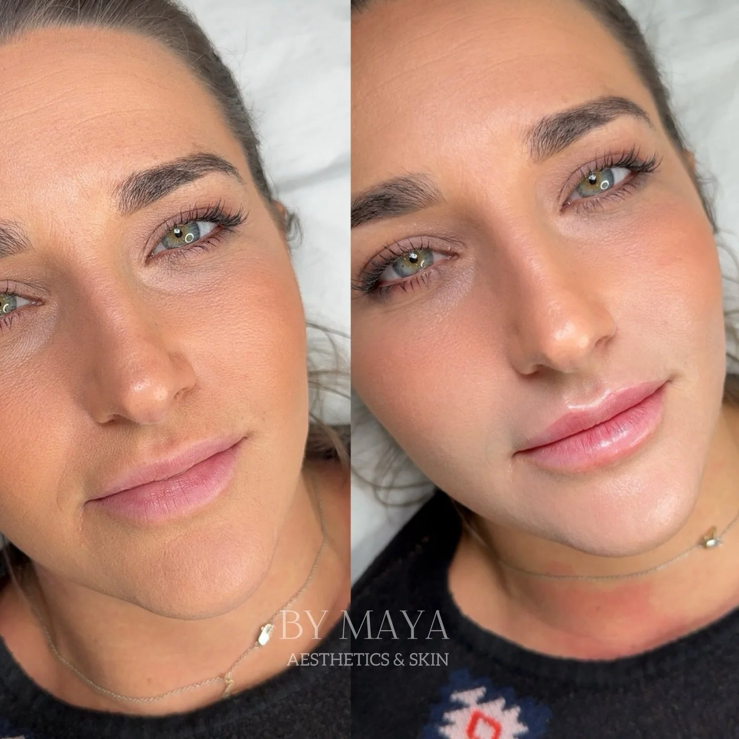 A small big change 🫦

It&rsquo;s all about natural beauty and enhancing what you already have 🩷
_______________________

#lipaugmentationlondon #flatlipsuk #lipaugmentationlondon