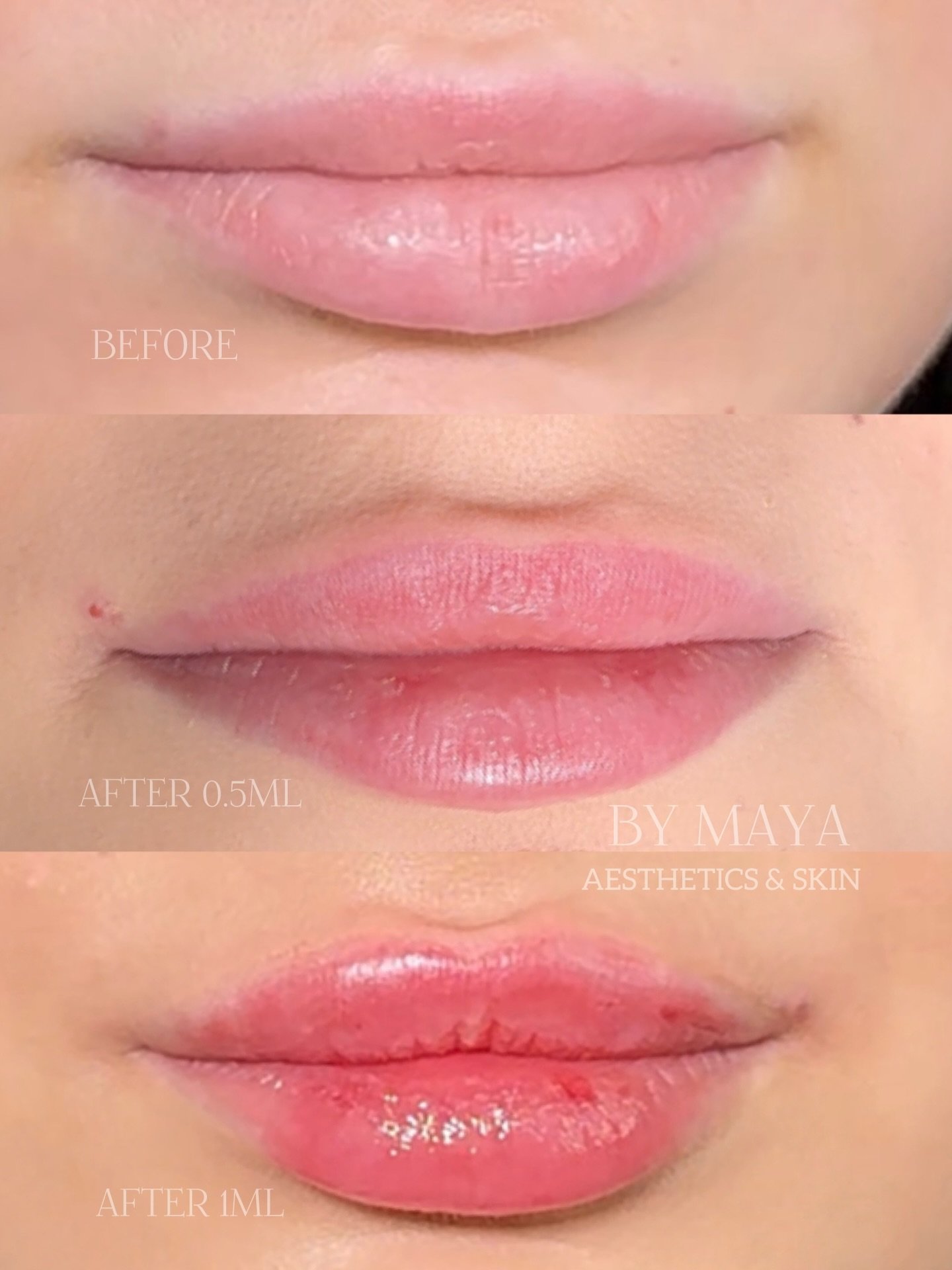 Look what 1ml of Derma Filler can do 😍👄

A subtle, natural change-enhancing your lips while keeping them looking like you.
Not loving your lips? Drop me a message 💌

______________________

#flatlipslondon #juv&eacute;derm #lipaugmentationlondon &