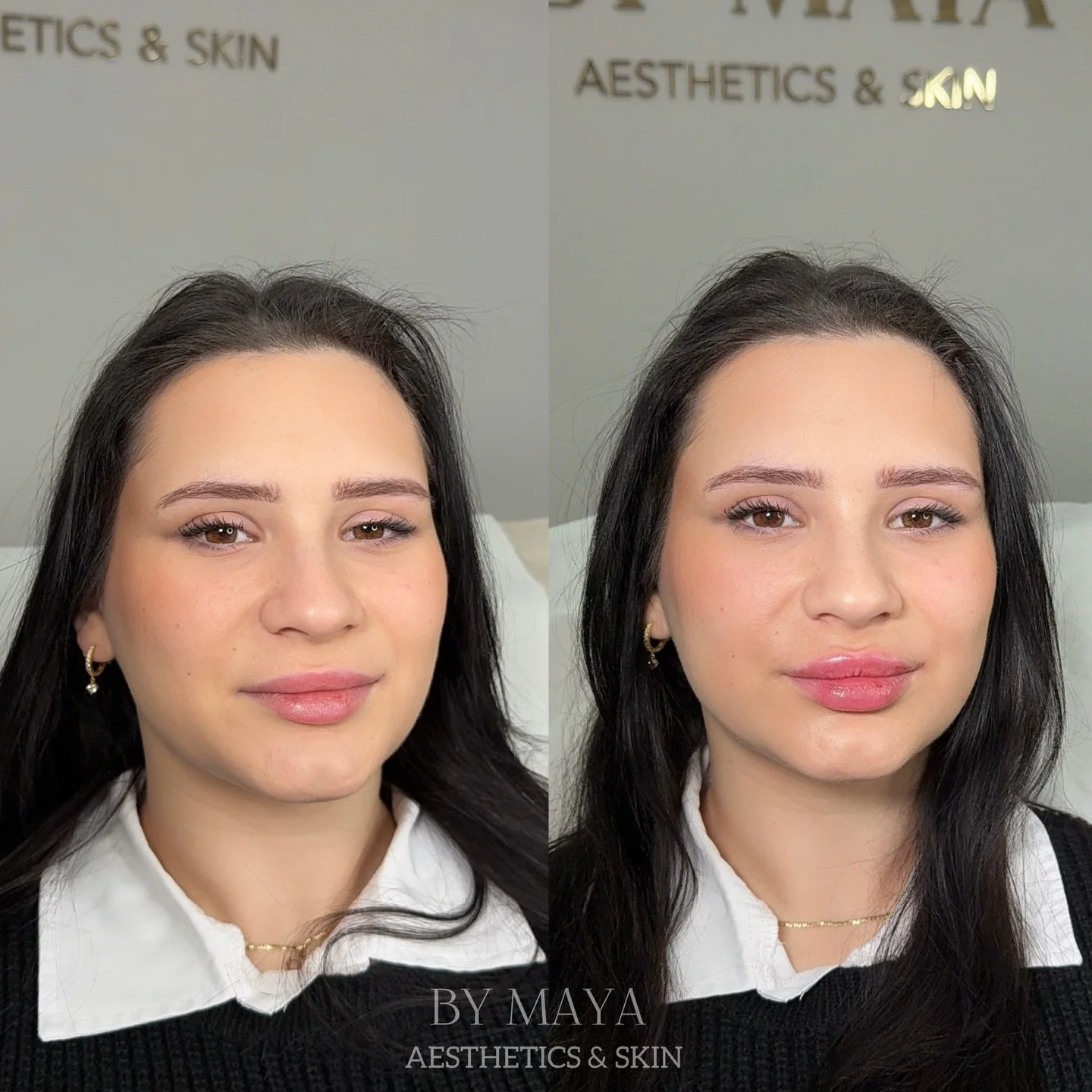 ✔️ flat, plump and natural. 🙂&zwj;↕️ My focus is on enhancing natural beauty. You won&rsquo;t find exaggerated transformations here 🙂&zwj;&harr;️ 

___________________

#flatlipslondon #lipfillerbattersea #lipfillerchelsea #lipaugementationlondon