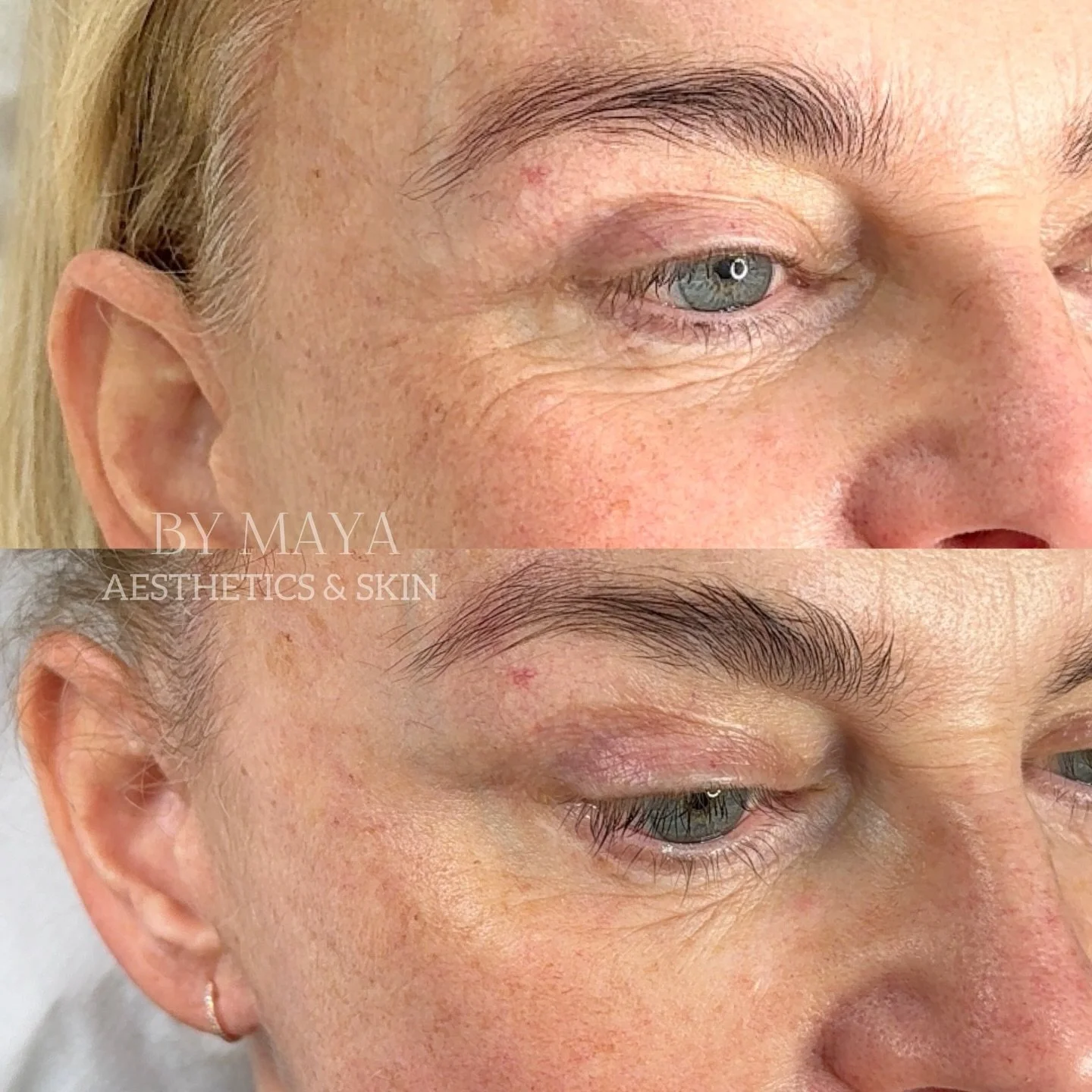 I love combining my unique techniques and products, built on the knowledge and experience I&rsquo;ve gained over the last few years.
Here is my lovely patient and her amazing results just 3 weeks after our first session of biostimulatores. 
I usually