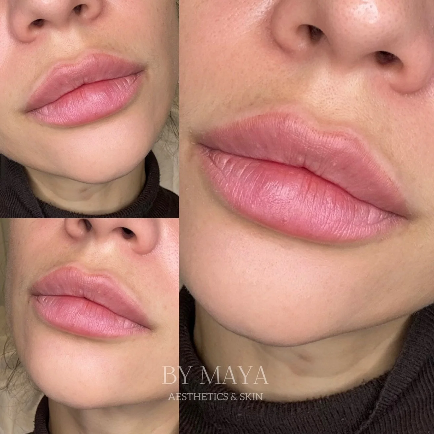 Healed 🤩 With the right technique and high-quality products, you won&rsquo;t even be able to tell there&rsquo;s 1ml of filler in the lips 😌

If you&rsquo;re not happy with your lip shape, I&rsquo;m here to help you. 
☎️ 07795 933120
 122 Battersea 