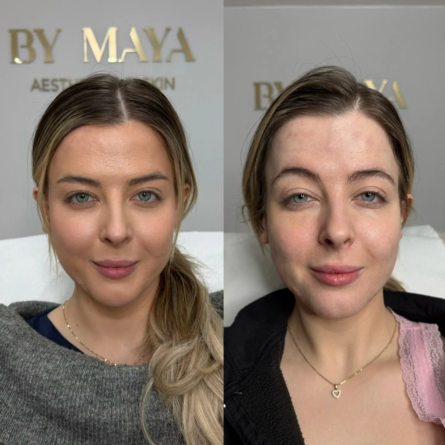 Happy clients = loyal clients.
With the right product, the right technique and the right dose, I achieve exceptional results.

✅ Reduced the distance between the brows and eyelids ✅ Subtly lifted the brows 
✅ Created a more open, refreshed eye appear