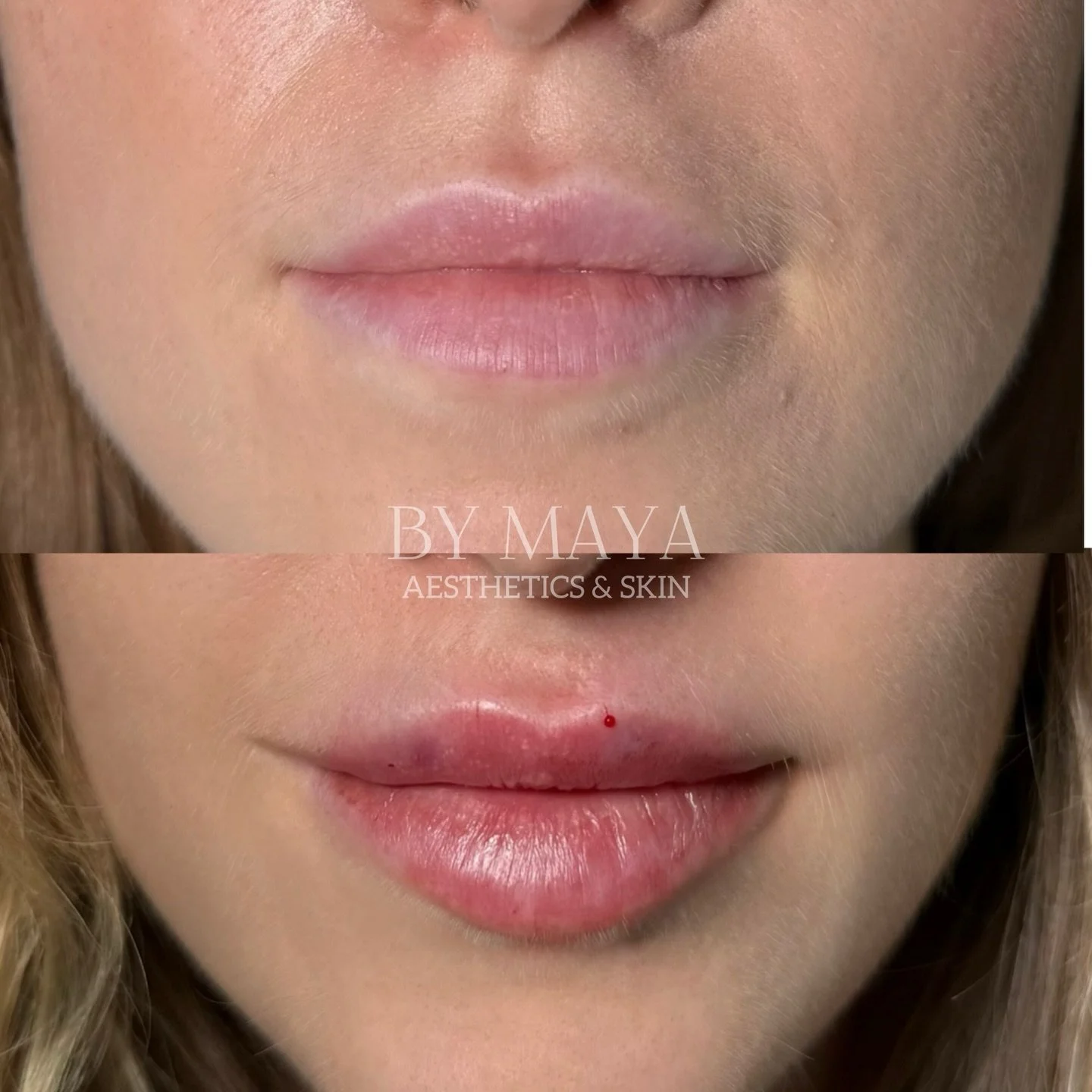 Before and 0.6ml after 👄

_______________

💌 DM me to book appointment, or send a message via WhatsApp: 07795 933120
📍 122 Battersea Park Road 

#flatlipslondon #juv&eacute;derm #lipaugmentationlondon &lrm;#شفاه #l&egrave;vres