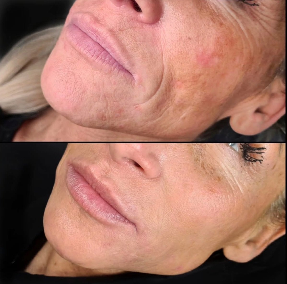 You don&rsquo;t always need dermal fillers to improve skin quality. While fillers restore volume and support the skin, biostimulators are designed to improve hydration, texture, and overall skin quality by stimulating collagen.

The choice of product