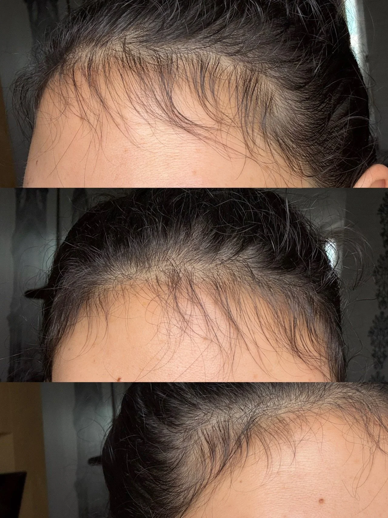 POV: you work in hair health and your own hairline starts thinning 😅
Plot twist - I turned it into my most personal case study yet.
3 months of a bespoke targeted regrowth protocol later, my baby hairs are literally back. Fine hair + hairline sheddi