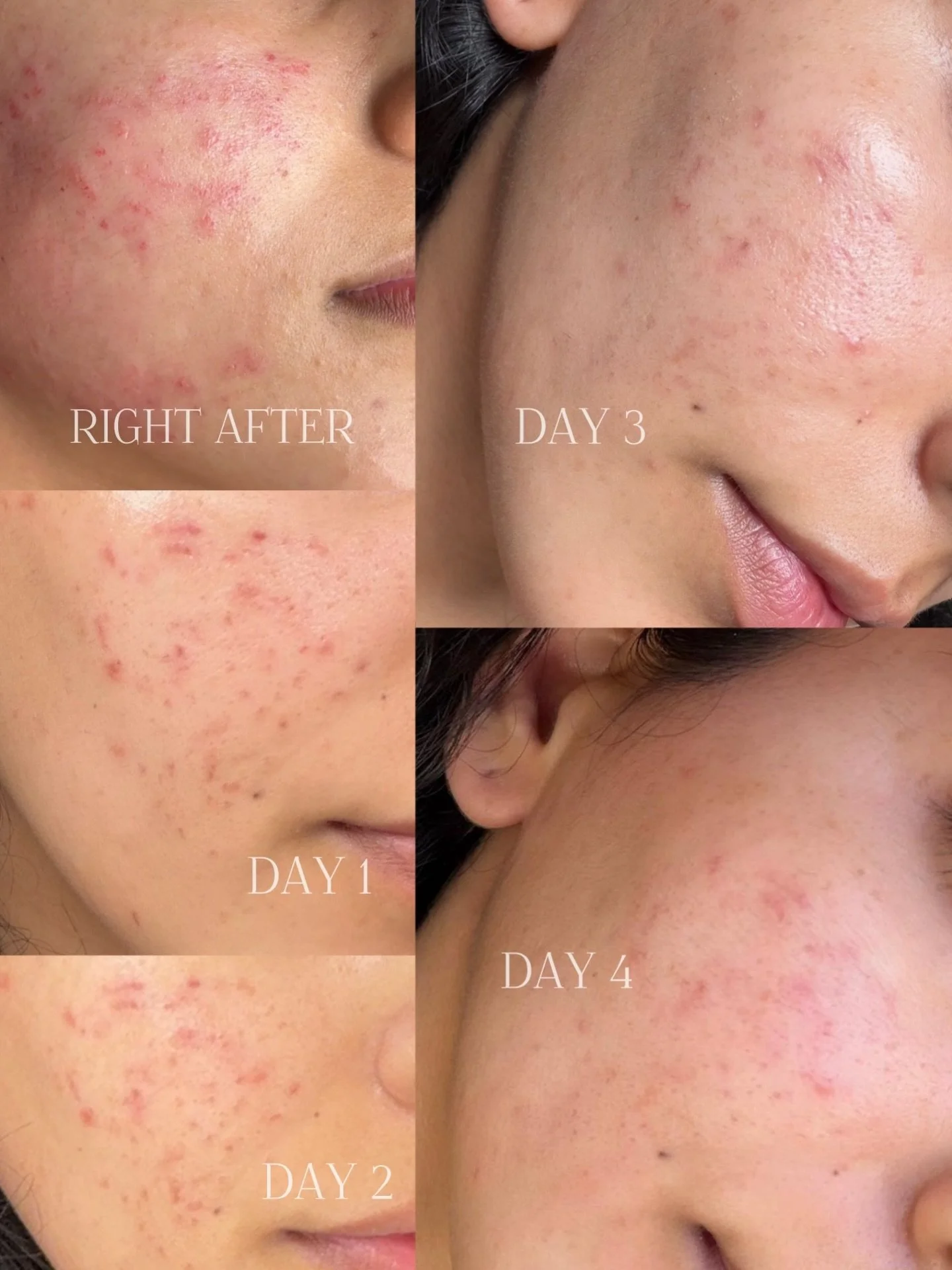 Scar Revision Treatment - this is a more advanced, slightly aggressive treatment, that&rsquo;s exactly why the results can be so transformative.

I wanted to show you the healing process so you know what to expect, as downtime can be a little longer 