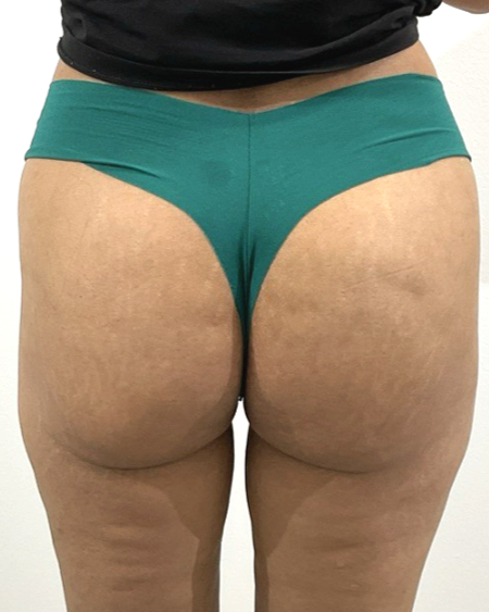 T-Shape 2 body sculpting before result