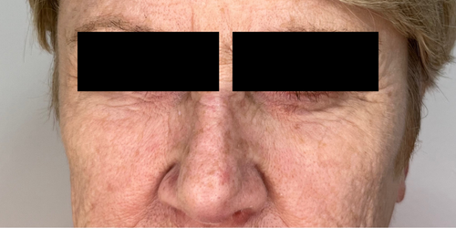 RF microneedling after result