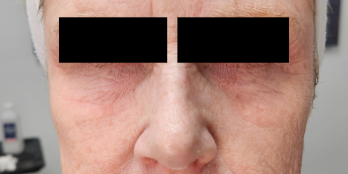 RF microneedling before result