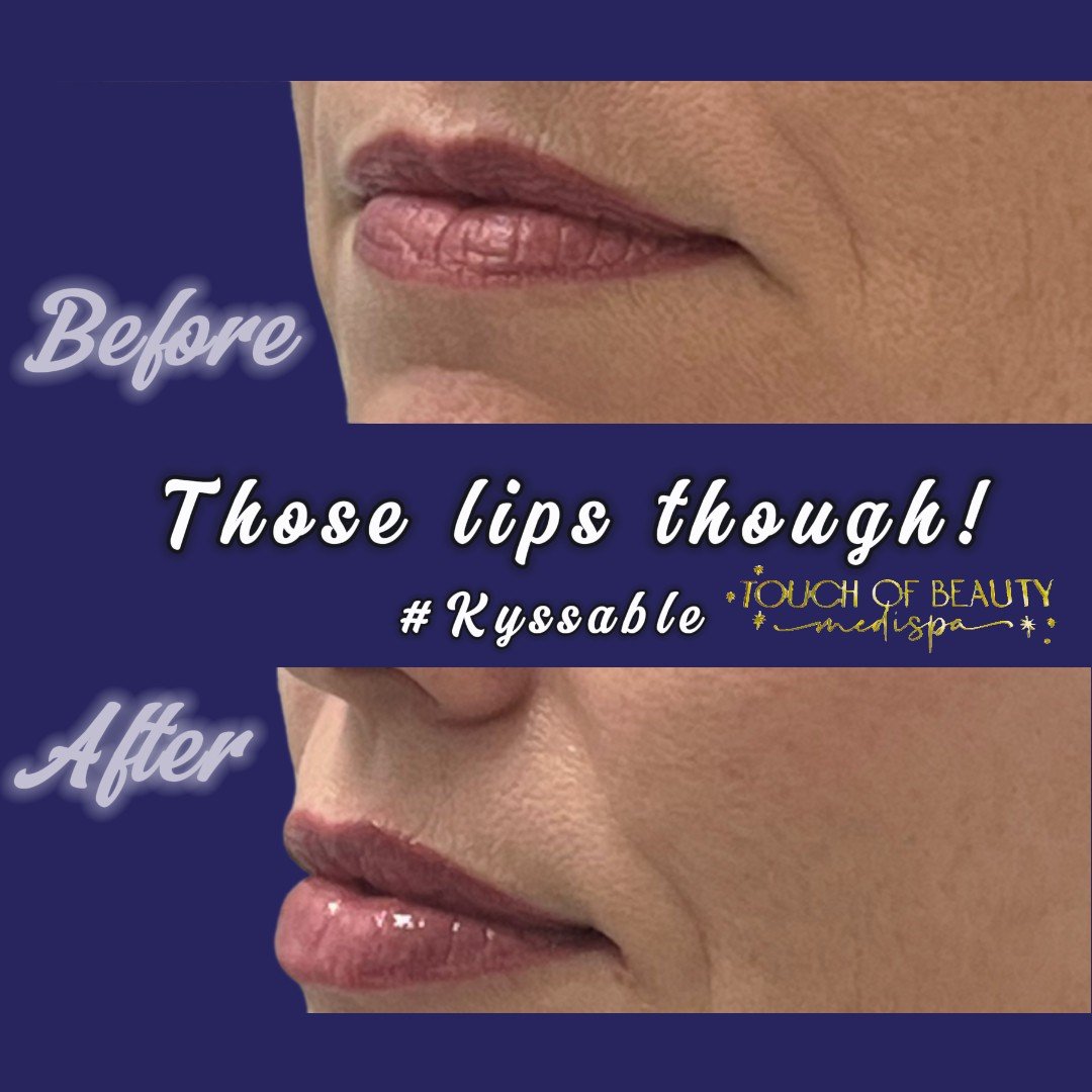 Before: Mild volume loss due to aging, with fine lines around the mouth.
After: Restored volume and smoothness for a more youthful appearance. Fine lines softened and lips regained a plump, hydrated look while preserving the patient's natural lip sha