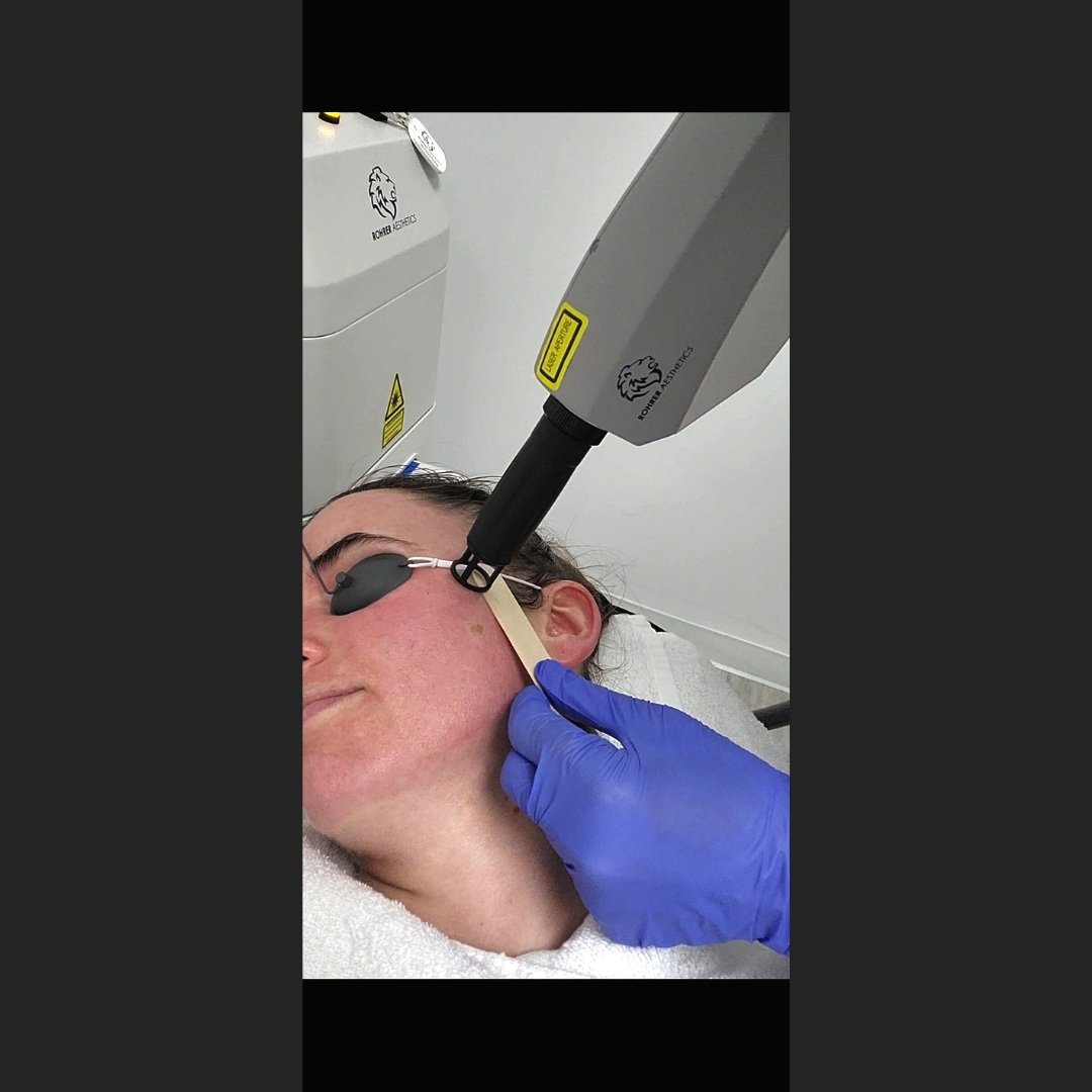 Spectrum Laser & IPL | Hair & Tattoo removal, Acne, Melasma & Rosacea ...