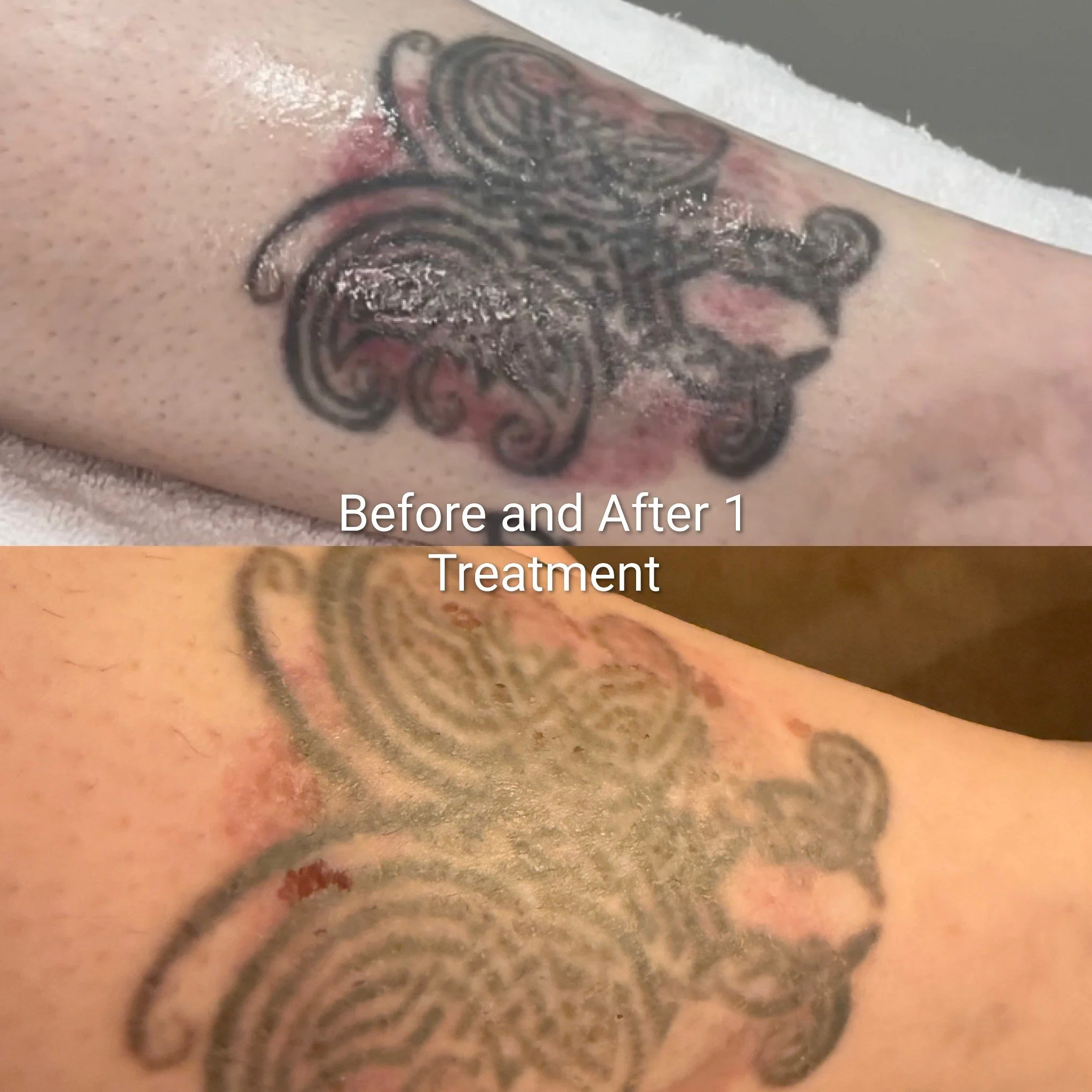 Before and after tattoo.JPG