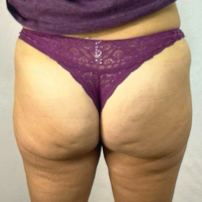 T-Shape 2 body sculpting after result