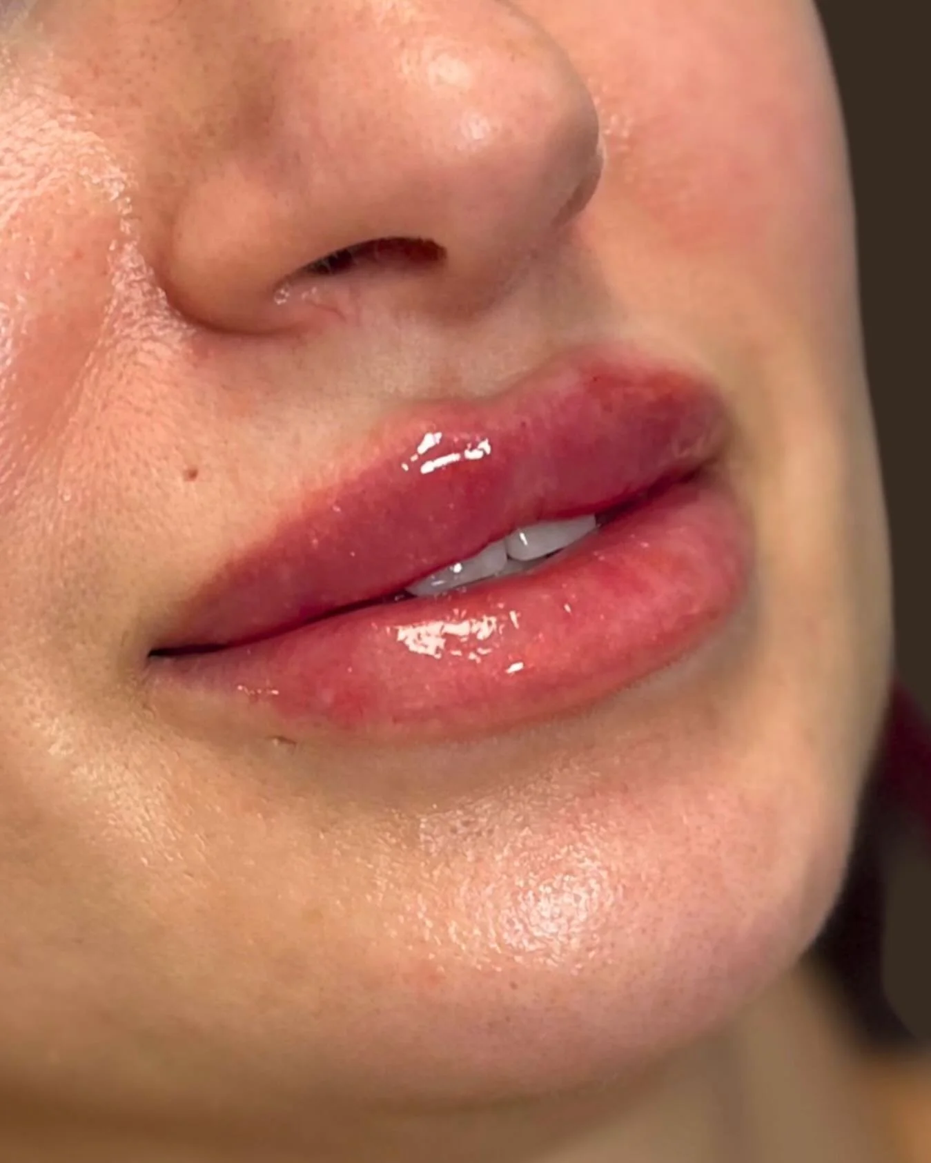 ☀️ Juicy summer lips are always in season at Sunset Aesthetics 💋⁠
Whether you&rsquo;re after a subtle refresh or a fuller pout, our Nurse Injector Amy will deliver natural results that are always beautiful &mdash; never overdone. ⁠🌸✨
⁠
Book your li