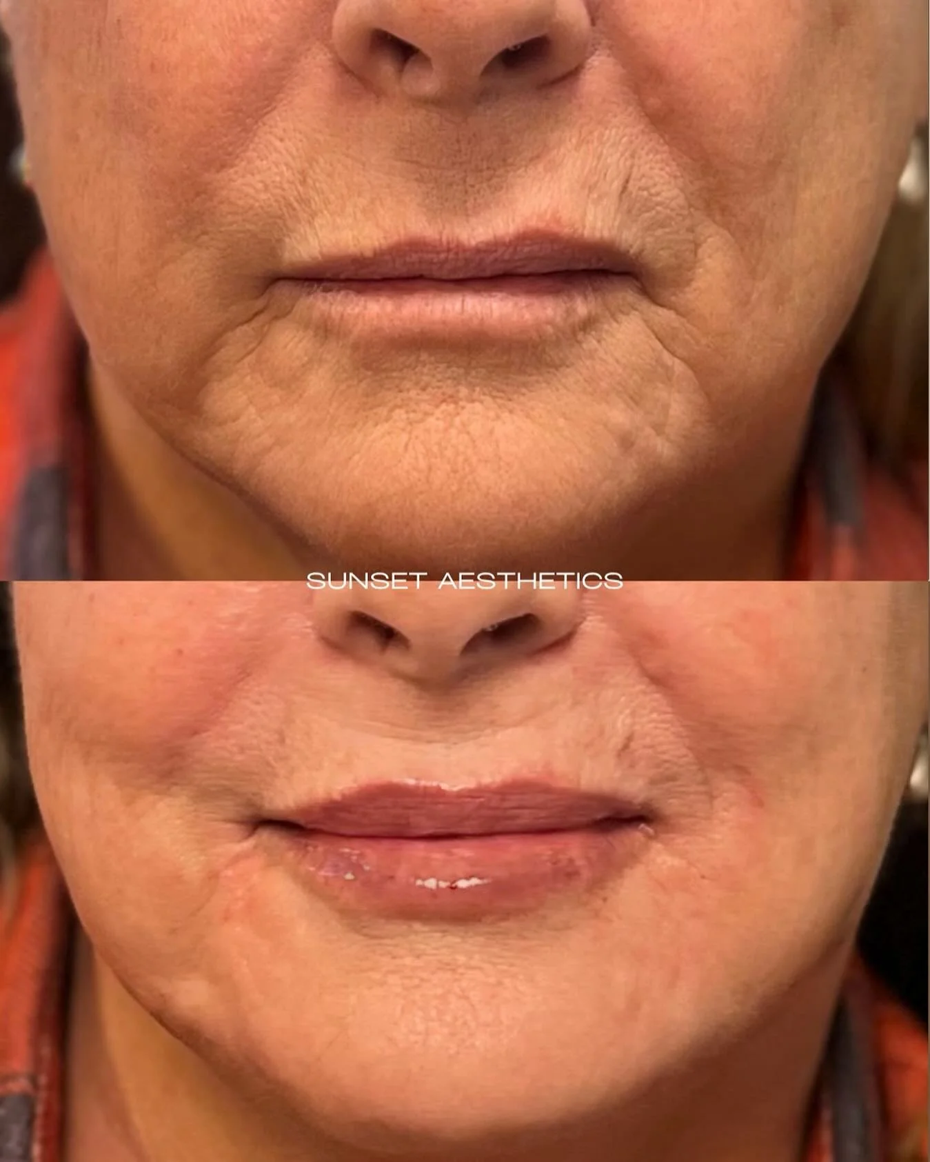 Beautiful results with strategically placed HA filler by our Co-Owner and Nurse Injector, @a_m_y_yocum ❤️
.
.
Facial balancing is a practice and an art. Subtle enhancements in the midface, jawline, peri-oral area and lips made a fantastic difference 