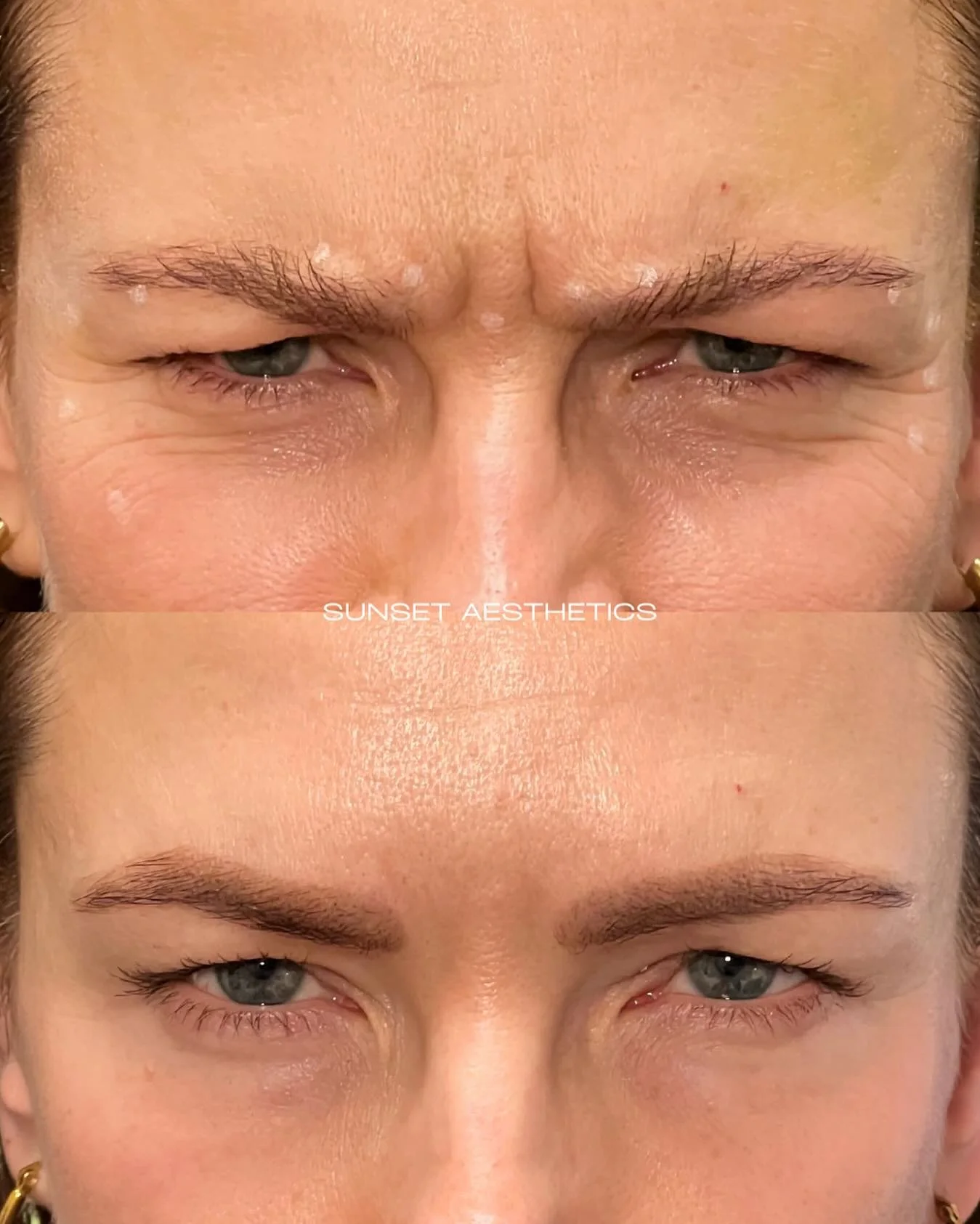 Smooth your 11s, soften your crow&rsquo;s feet, and step into the holidays 🎄looking refreshed!!
Book your pre-holiday TOX &mdash; your future photos will thank you. 😉 

If you&rsquo;re a NEW CLIENT we have some great specials running!! $9/unit for 