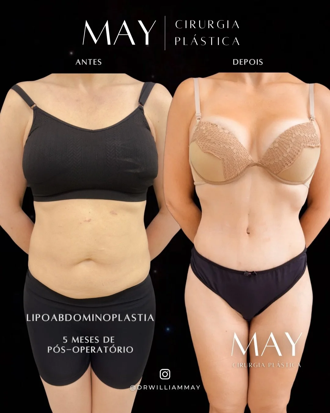 Transforma&ccedil;&atilde;o que vai al&eacute;m da est&eacute;tica ✨

A lipoabdominoplastia &eacute; um dos procedimentos mais completos quando o objetivo &eacute; redefinir o contorno corporal com naturalidade e harmonia. Neste caso de antes e depoi