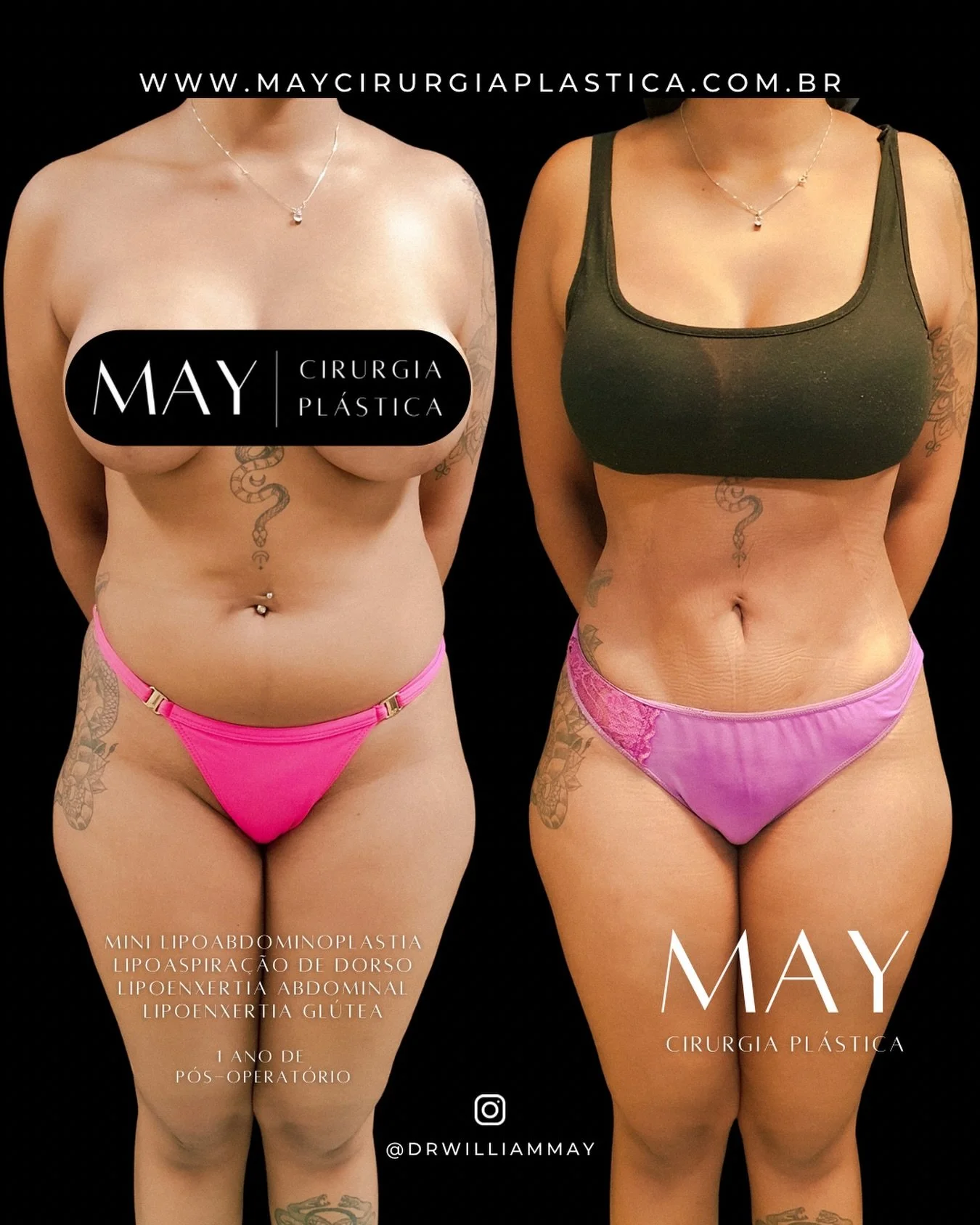 Refinamento do Contorno Corporal com Cirurgias Combinadas

Neste caso de antes e depois, realizamos a associa&ccedil;&atilde;o de quatro procedimentos para esculpir e refinar o contorno da paciente: Mini-Abdominoplastia + Lipoaspira&ccedil;&atilde;o 