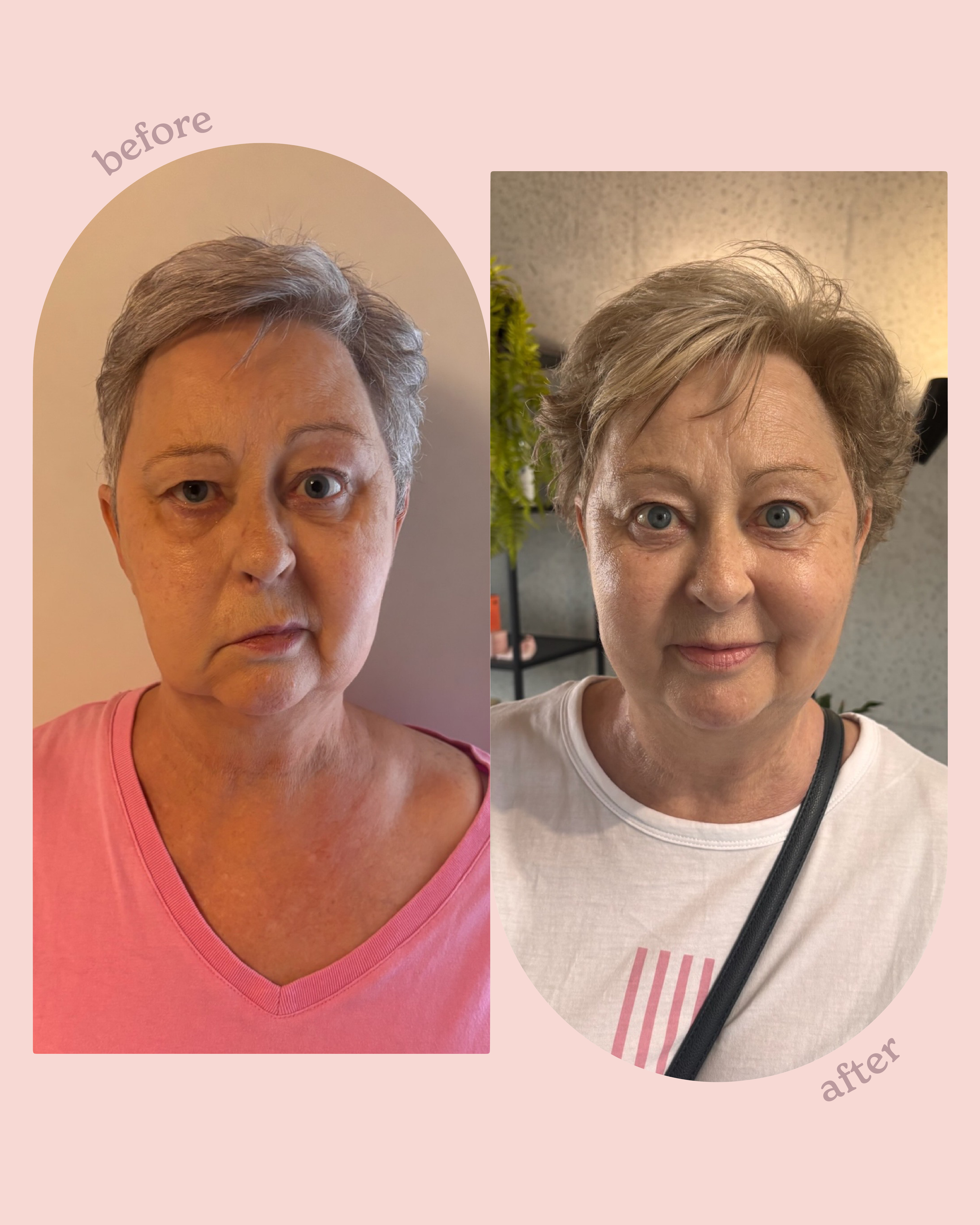 facial nerve paralysis ~ treatment