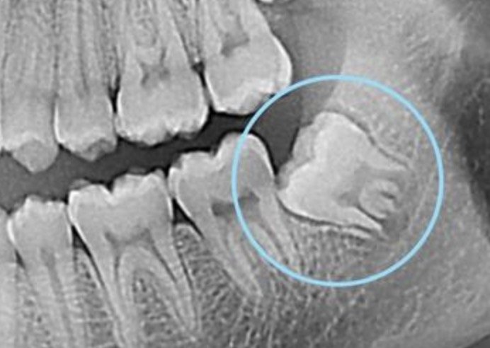 Qu’est-ce qu’une           dent de sagesse ?