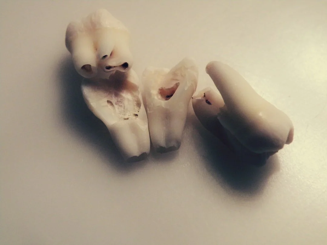 Risks and Considerations of a Root Canal: What You Need to Know