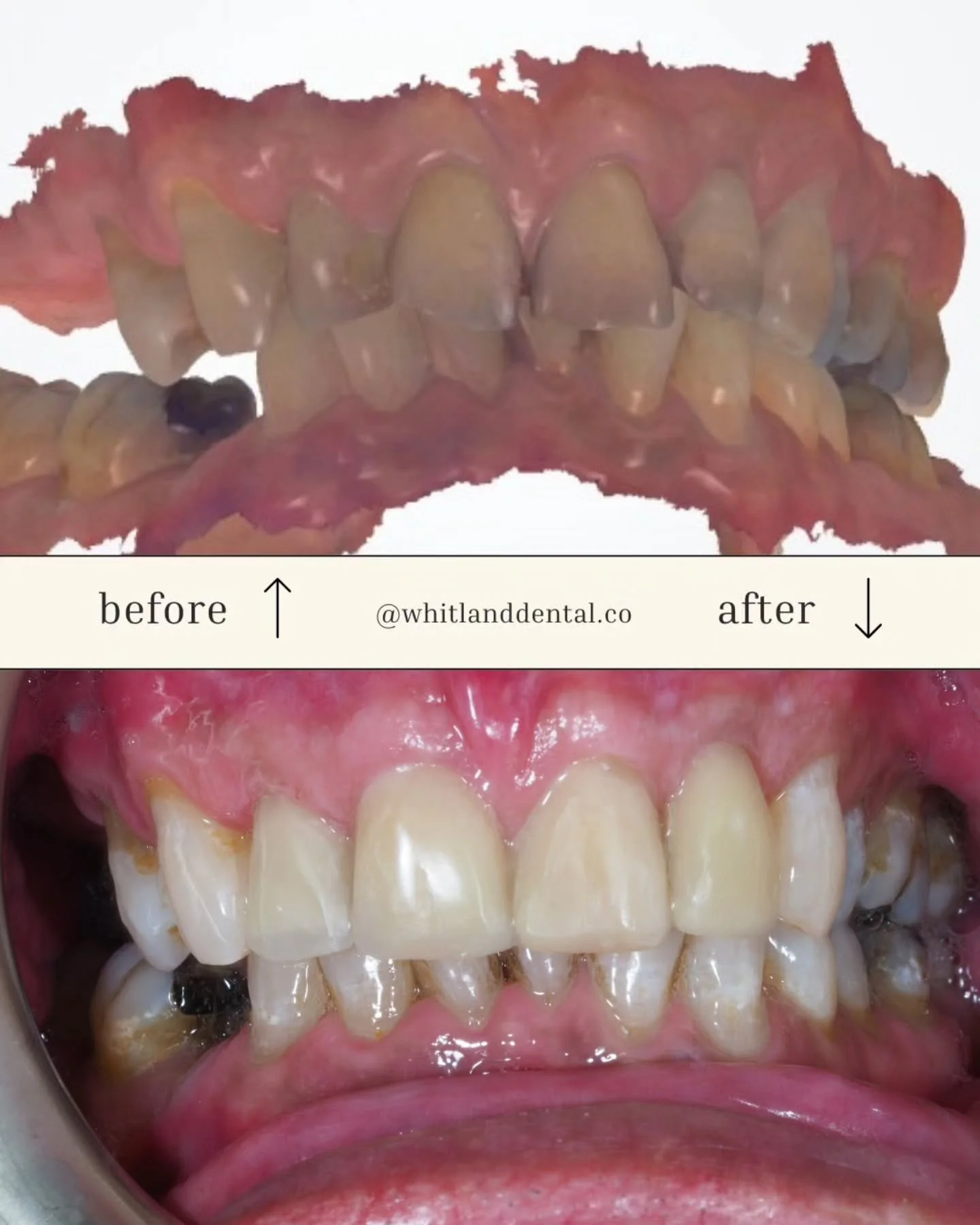 This 70 year old male had old, discoloured composites, uneven wear facets and dark teeth. Wear and tear like this can add years and affect your self confidence.

We scanned his teeth and @swiftdentalgroup created a 3D printed mock up of the teeth.

O