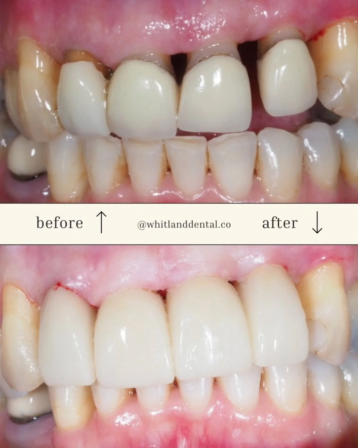 This anterior crown refresh was definitely needed after combining a multi-clinic approach.

First the pateint was referred to a gum treatment specialist and once stable, came back to us to change the crowns.

We switched the old porcelain-metal crown