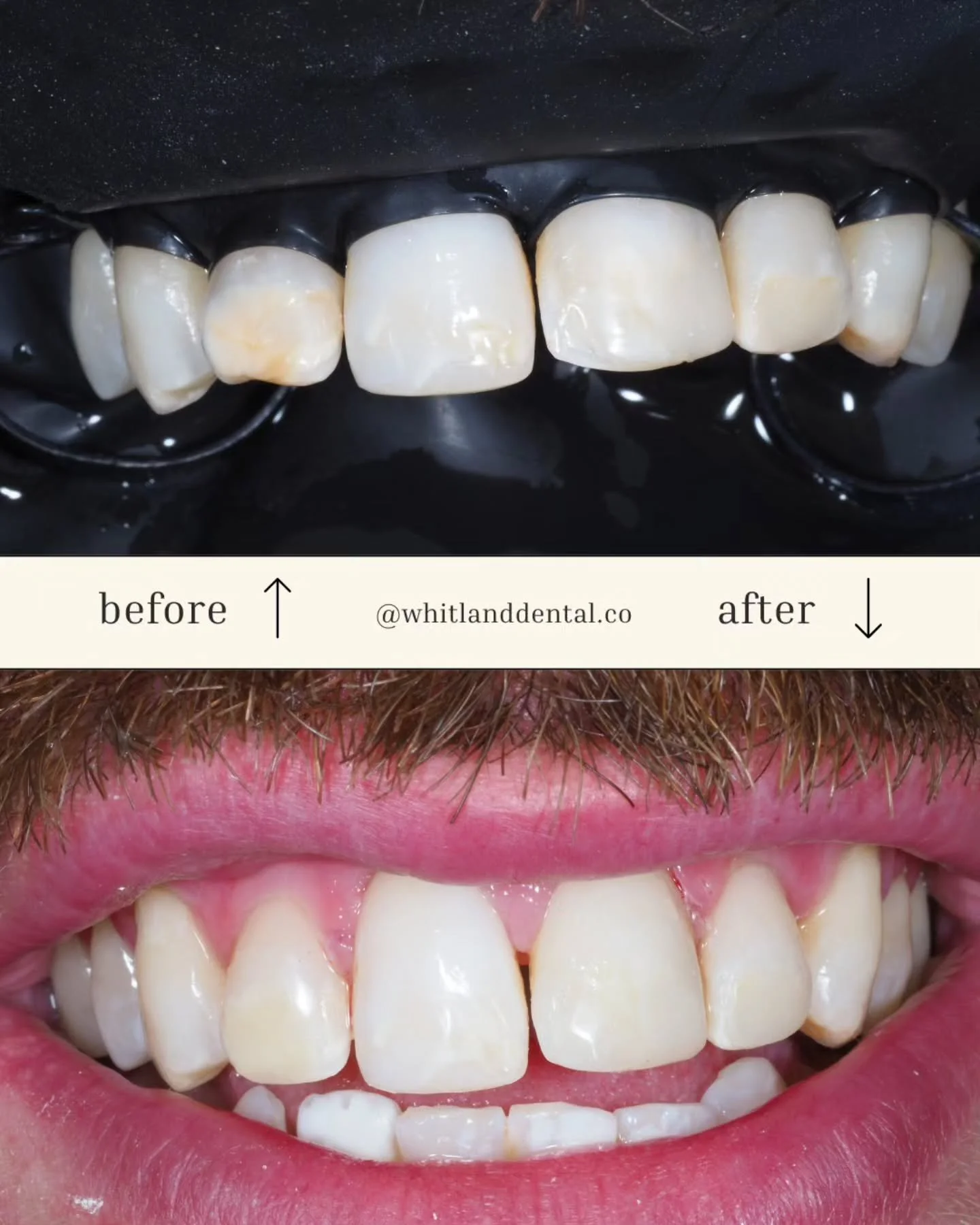 ❌️ No Drilling ❌️
This young man had had a consultation for crowns in Turkey. They would have drilled his teeth down to stumps and covered them in thin zirconia which comes with permanent tooth structure removal and nerve risk.

✅️ ICON Treatment ✅️ 