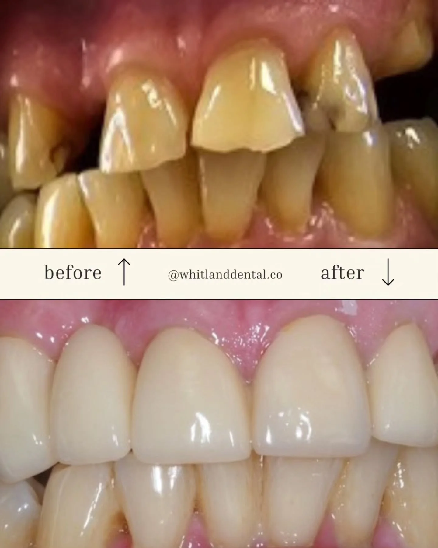 This older gentleman was concerned about the gaps, wear and discolouration that aged his smile.
With zirconia crowns and bridges we made his smile feel natural, bright and balanced.
#smilemakover #asanctuarynotasurgery #cosmeticdentisty #restoratived