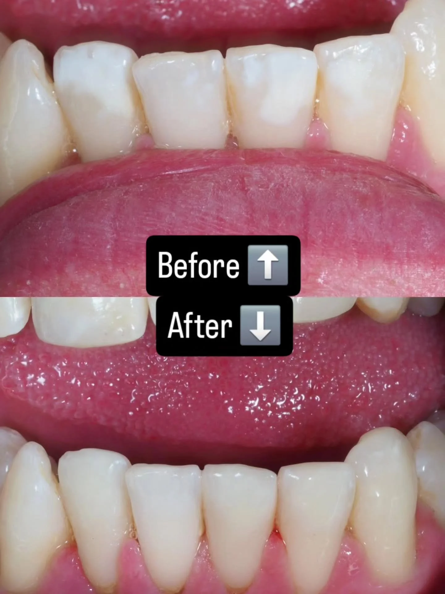 🟢ICON treatment 
❌️No Drilling
📸 No filters
🦷 Natural smile

#asanctuarynotasurgery #naturalsmile #cosmetıcdentıstry