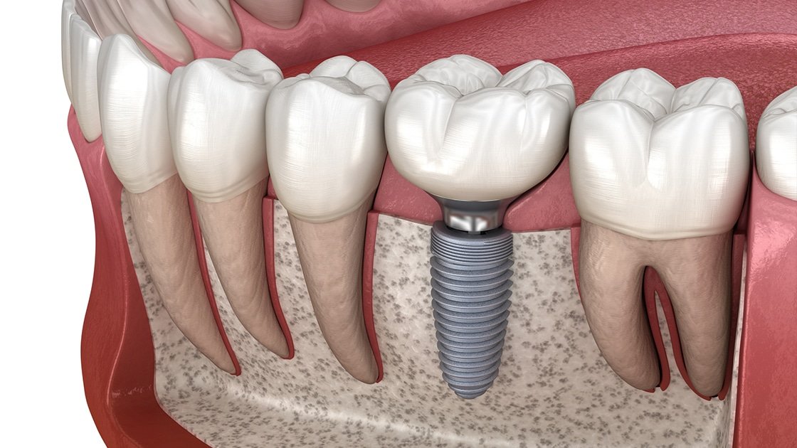 Implants dentaires