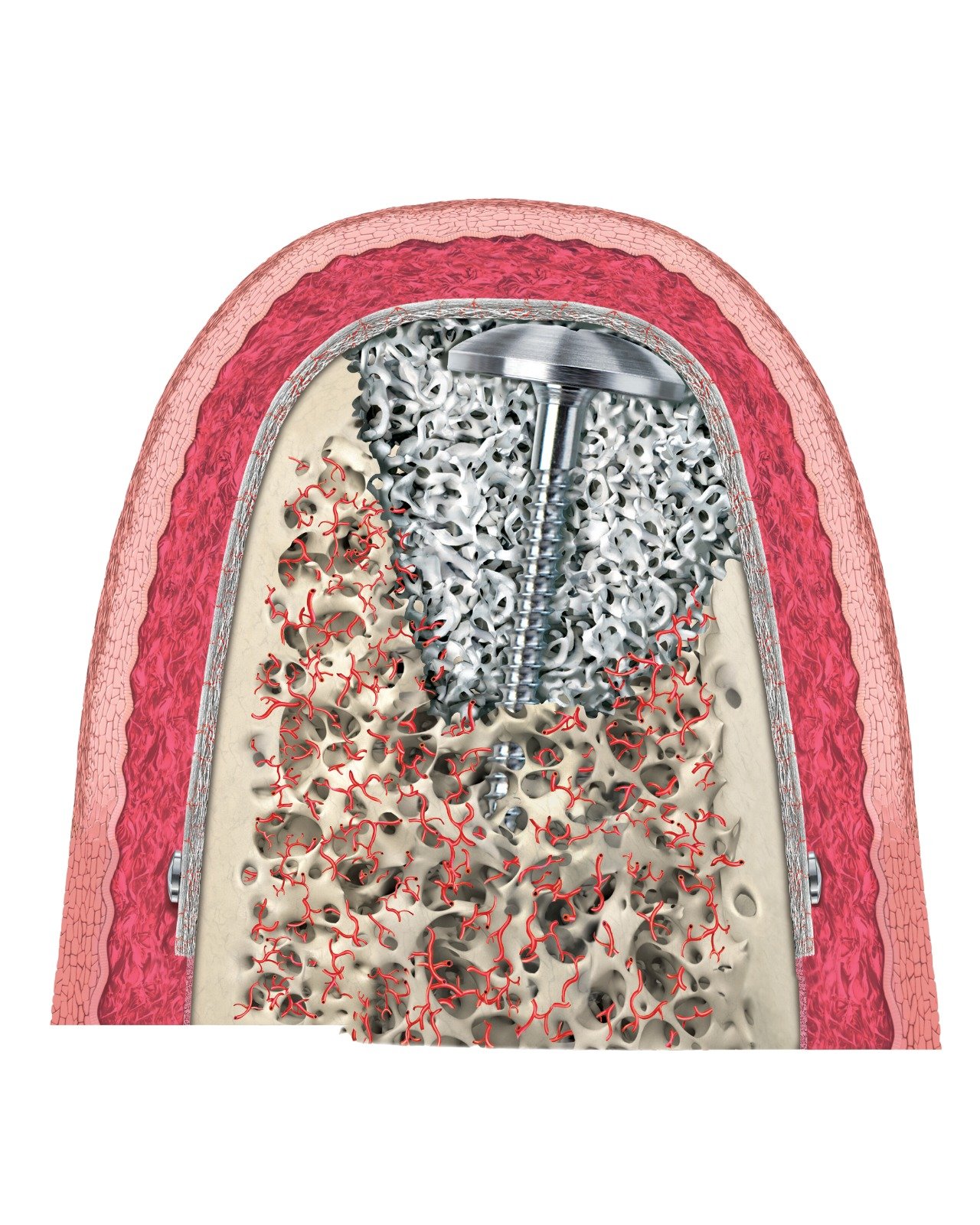 Greffes osseuses implantaires
