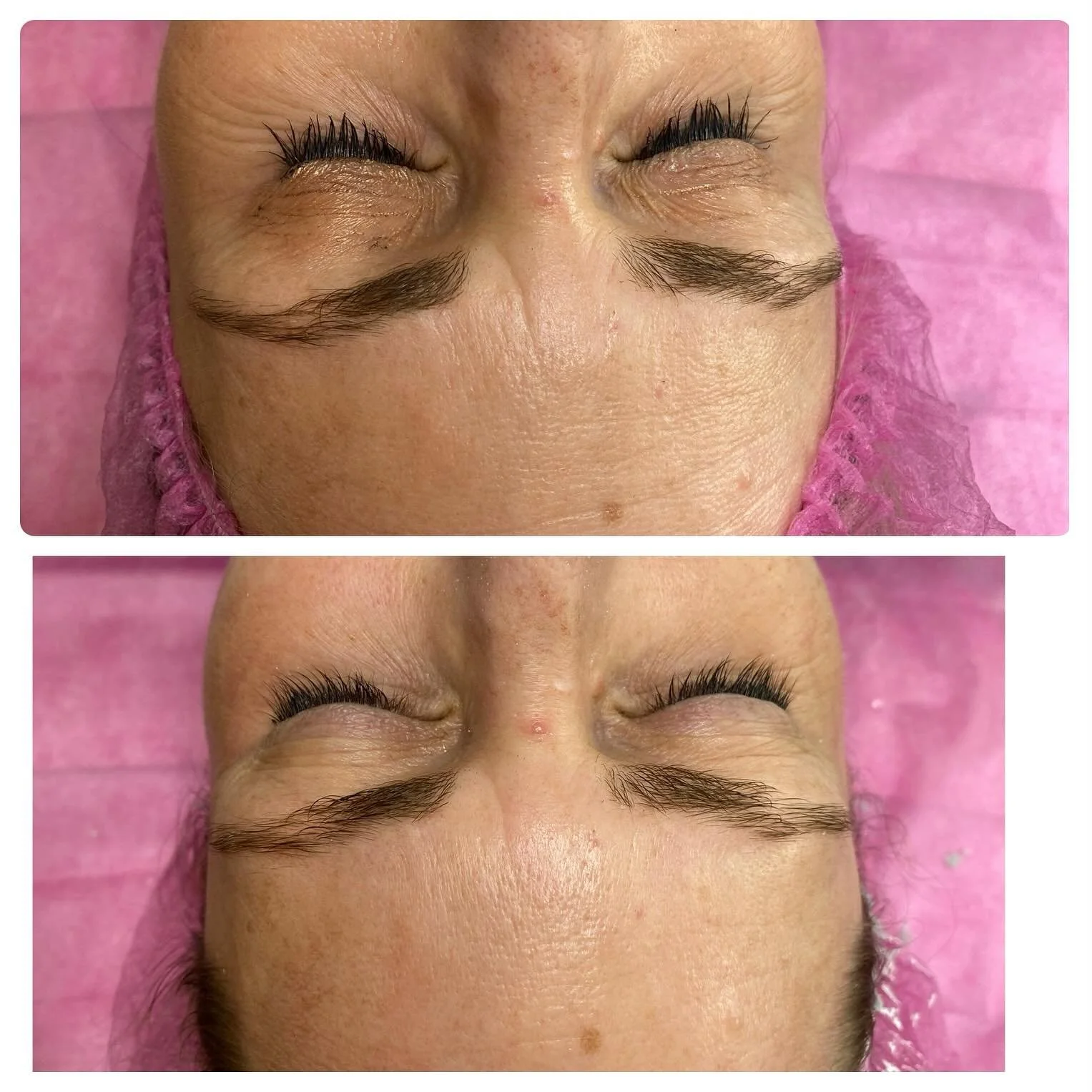 Mandel fr&uuml;chtpeeling 40% Behandlung 🥰