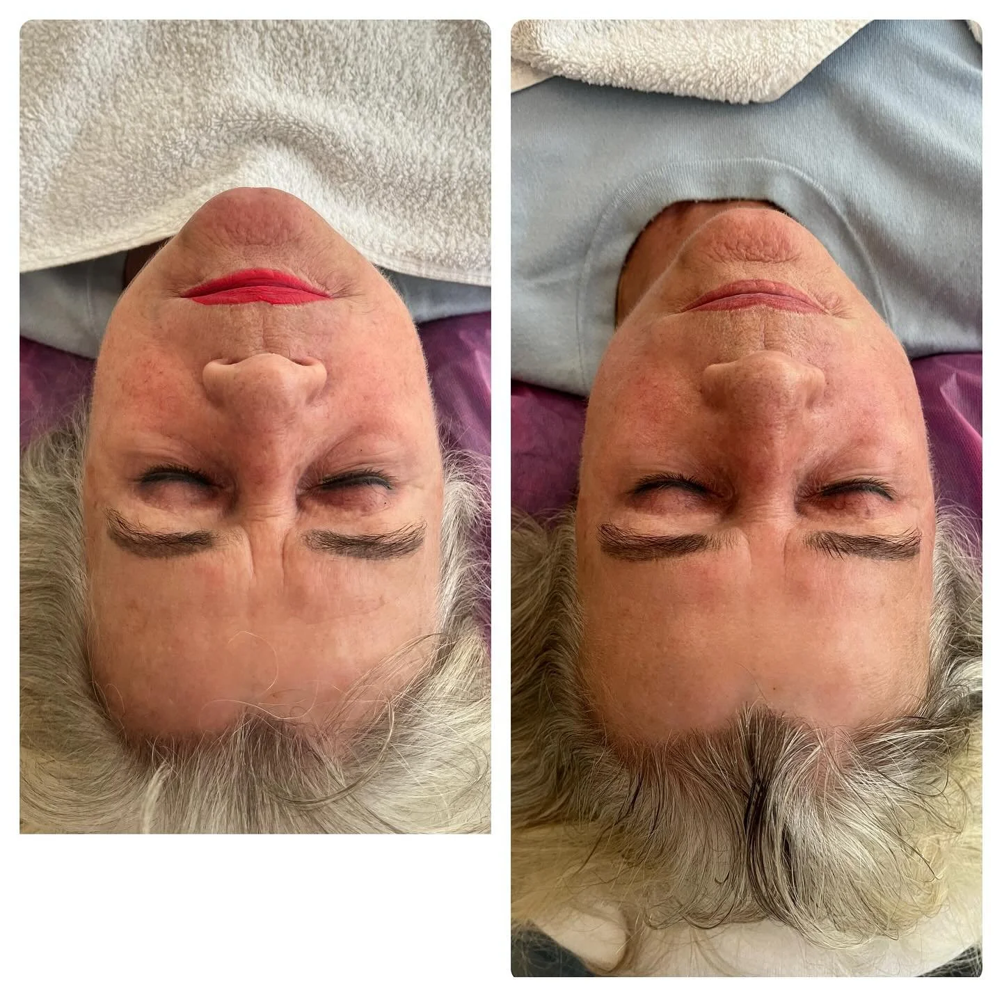 Kobido Lift Massage vor und direkt nach Behandlung 🥰