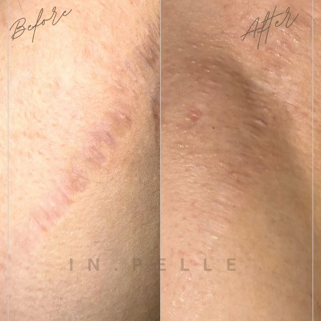 Level 1 – Scar Refinement