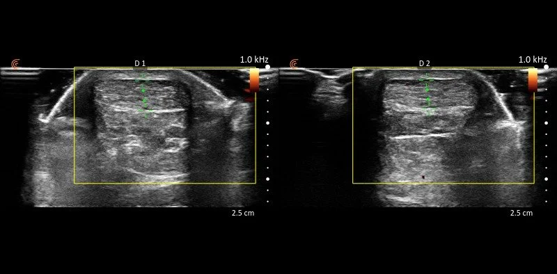How Ultrasound Helps Diagnose Foot and Ankle Pain