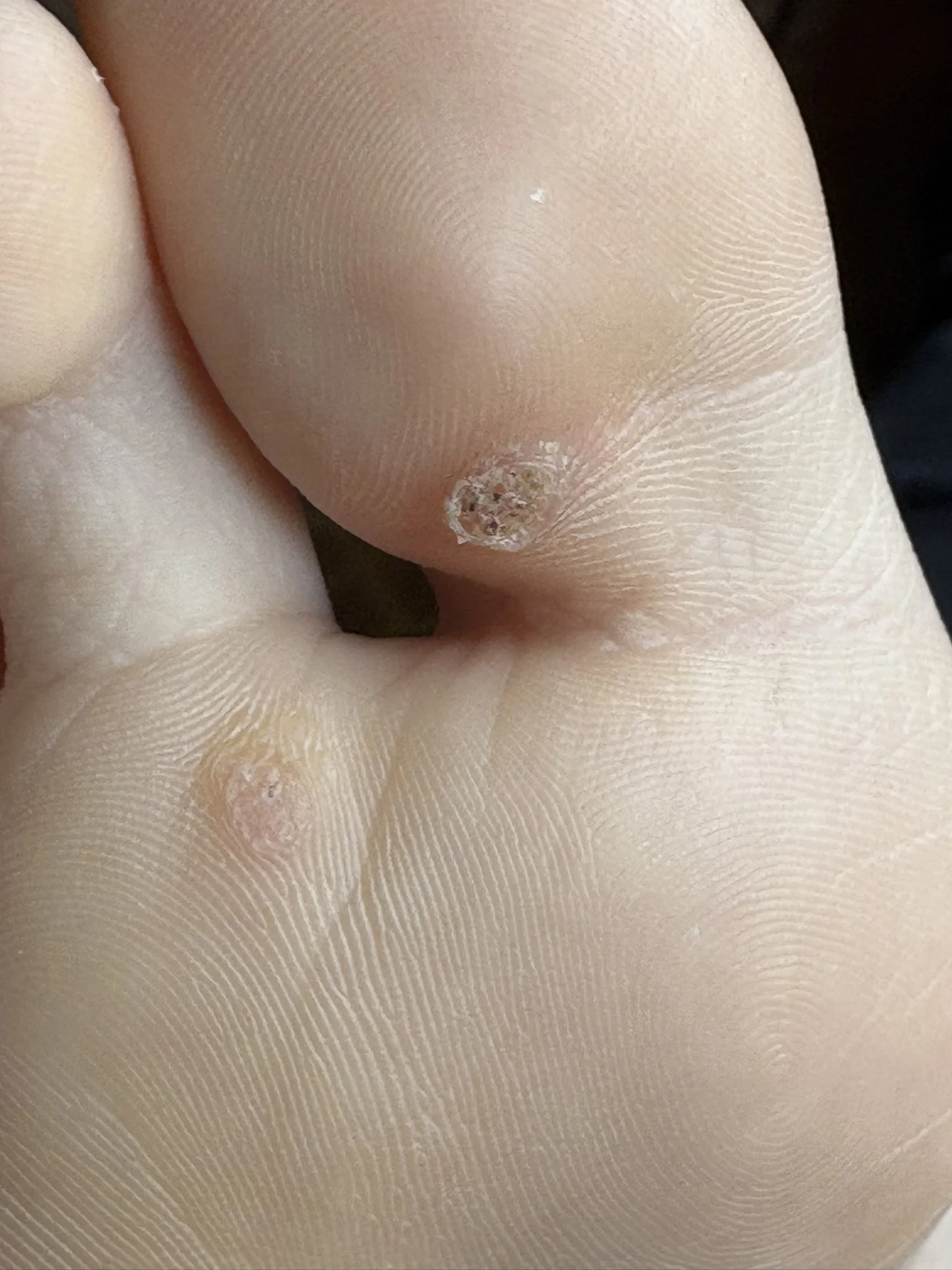 verrucae on foot
