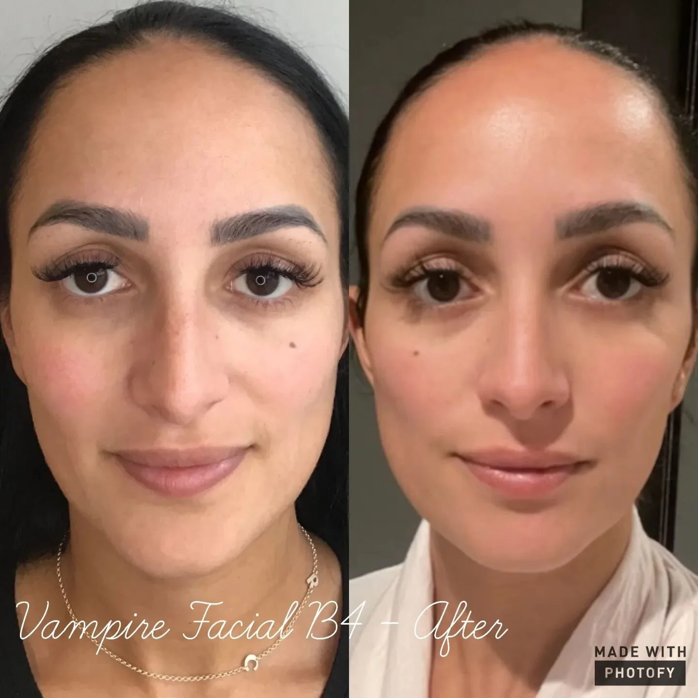 Results achieved by SkinPen &amp; PRP