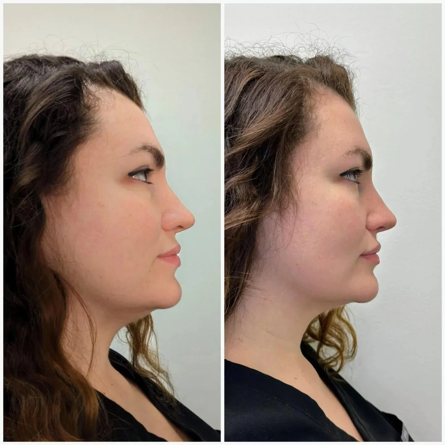 Morpheus 8

My amazing results 1 month after 1 session !

Started noticing sagging at jawline after losing 25lbs ( a.k.a &quot;ozempic face&quot; ). Now tackling it with Morpheus to tighten the skin and improve the jawline. Stay tuned as I keep you p