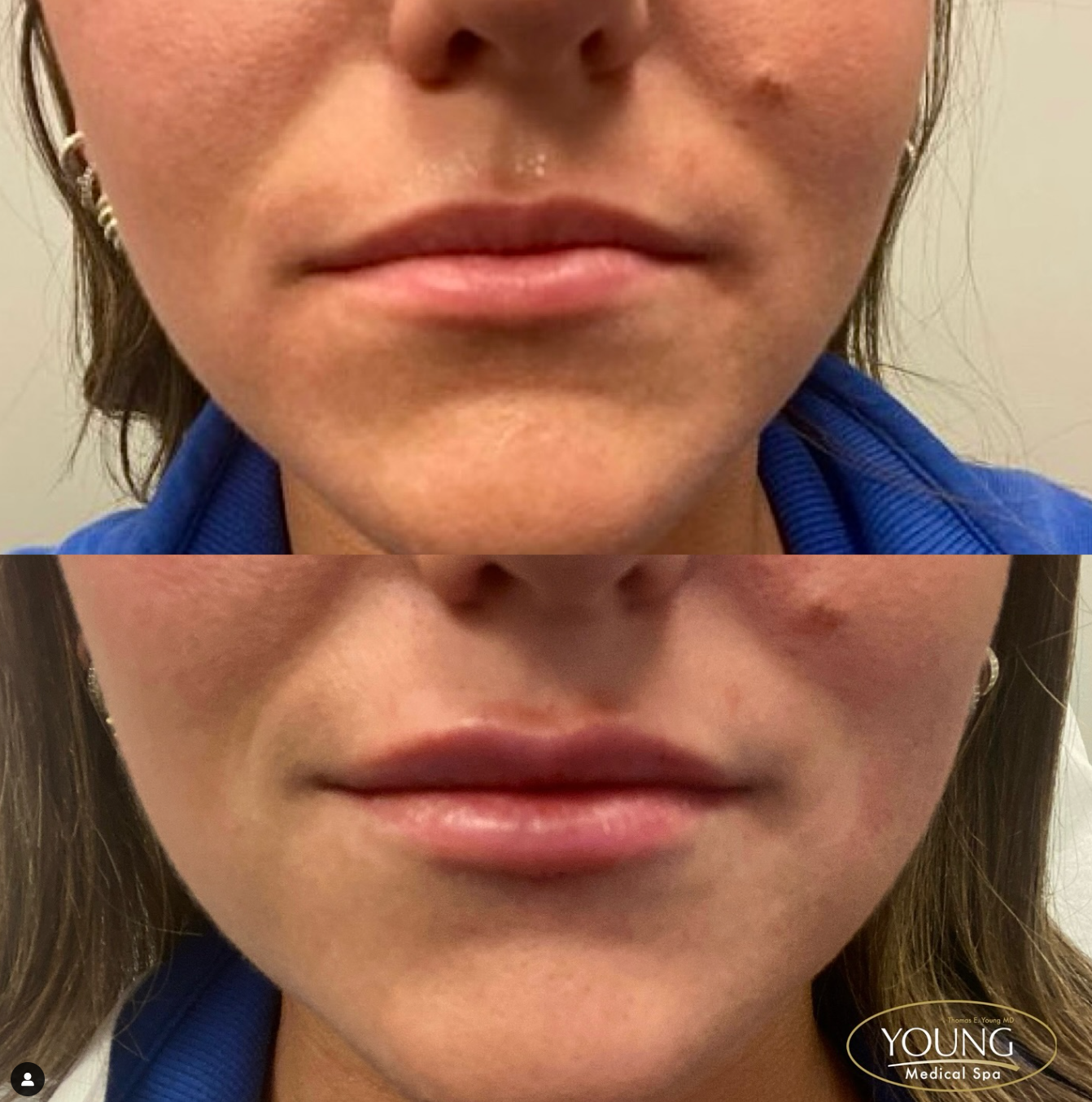 Lips b4 and after.png