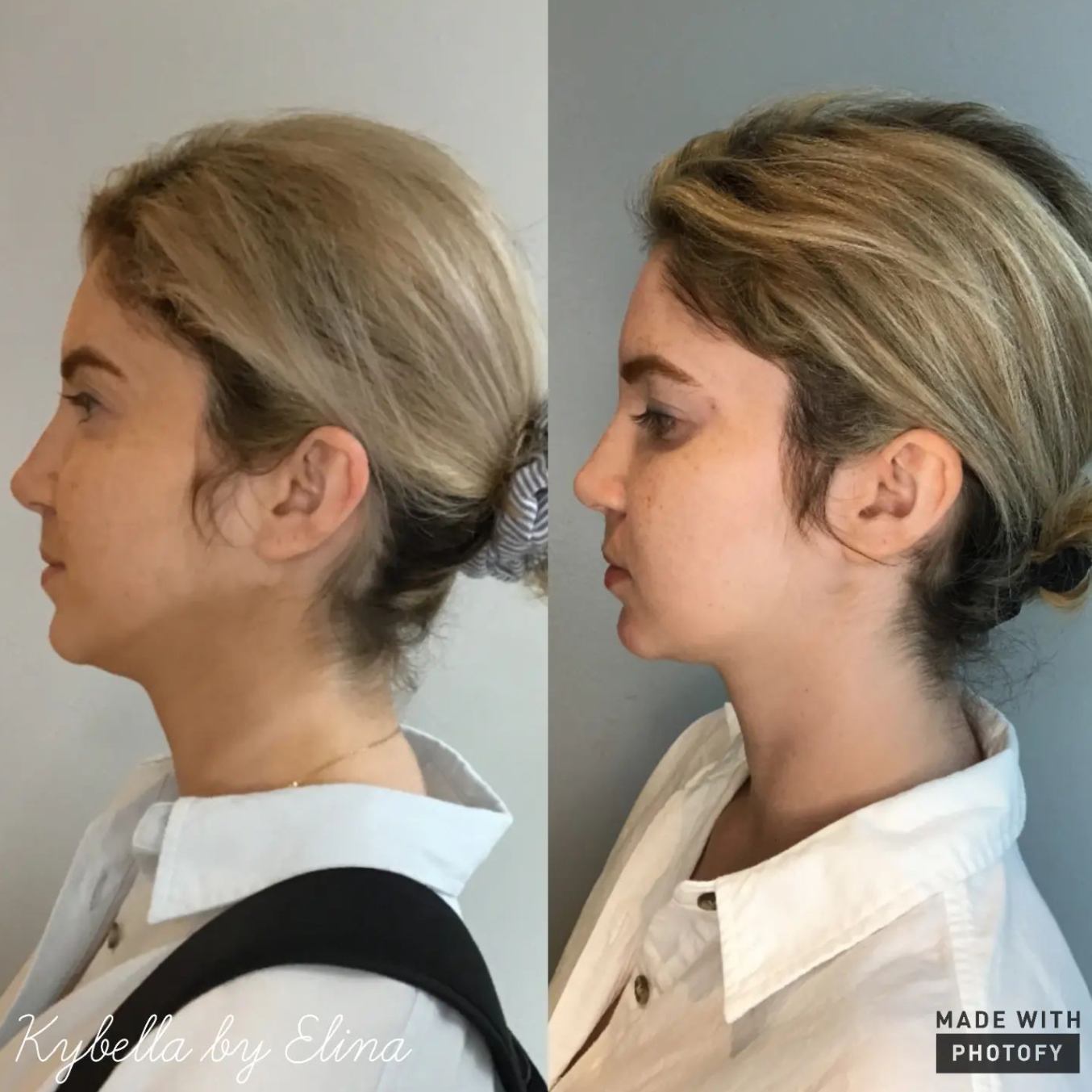 Kybella b4 after.png